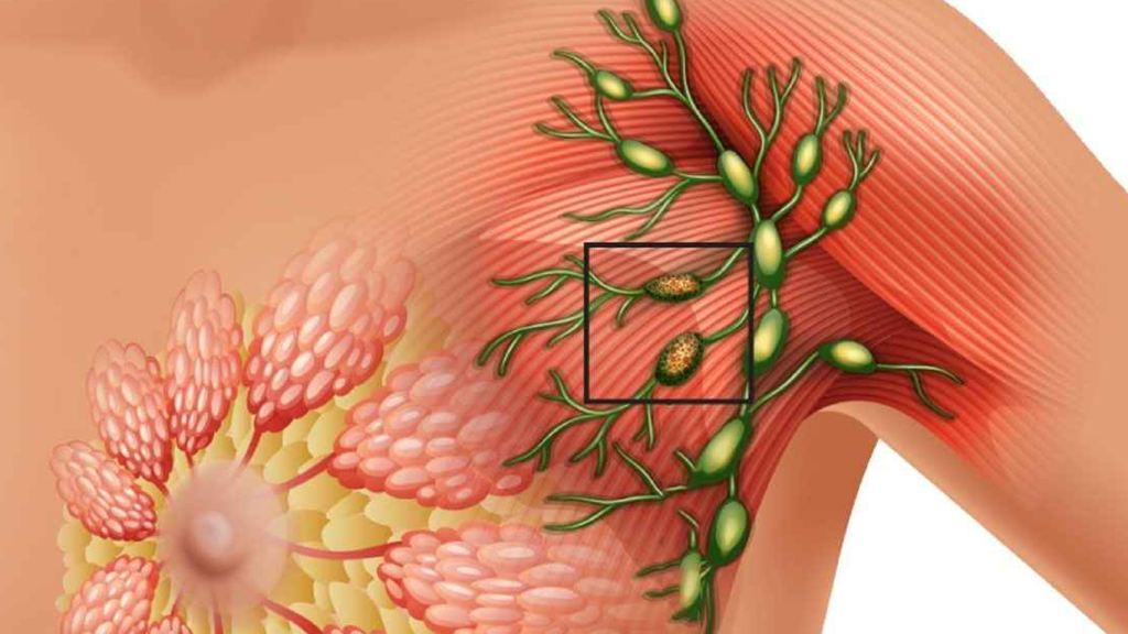 سرطان سینه بدخیم