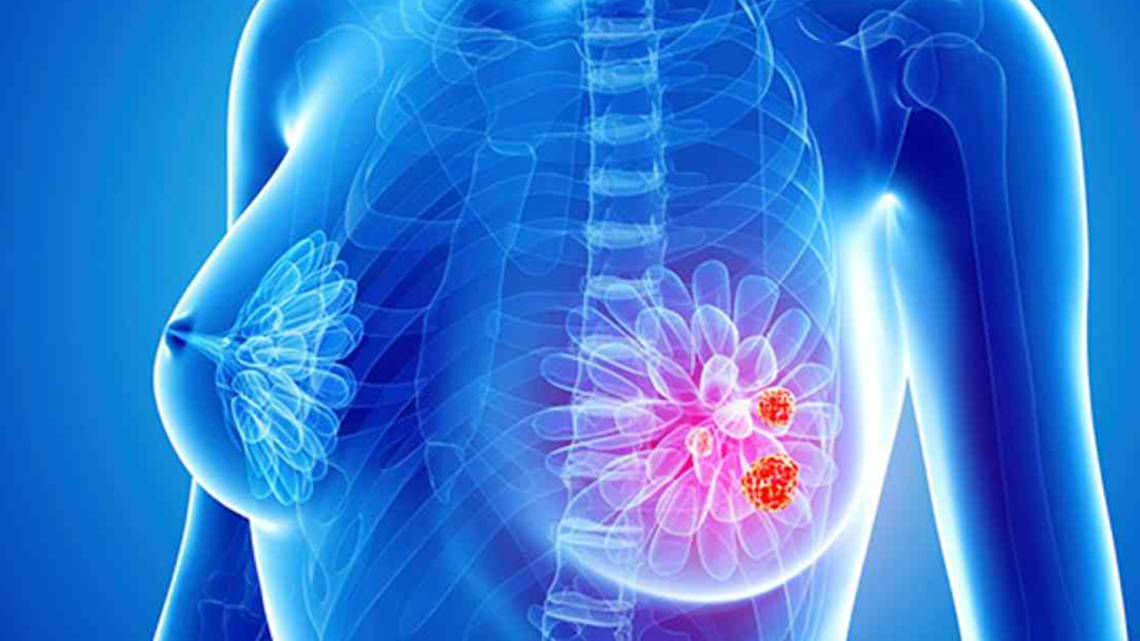 درمان سرطان سینه چگونه است